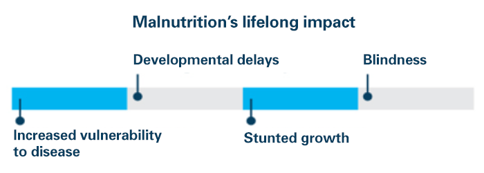 Image result for malnutrition in children