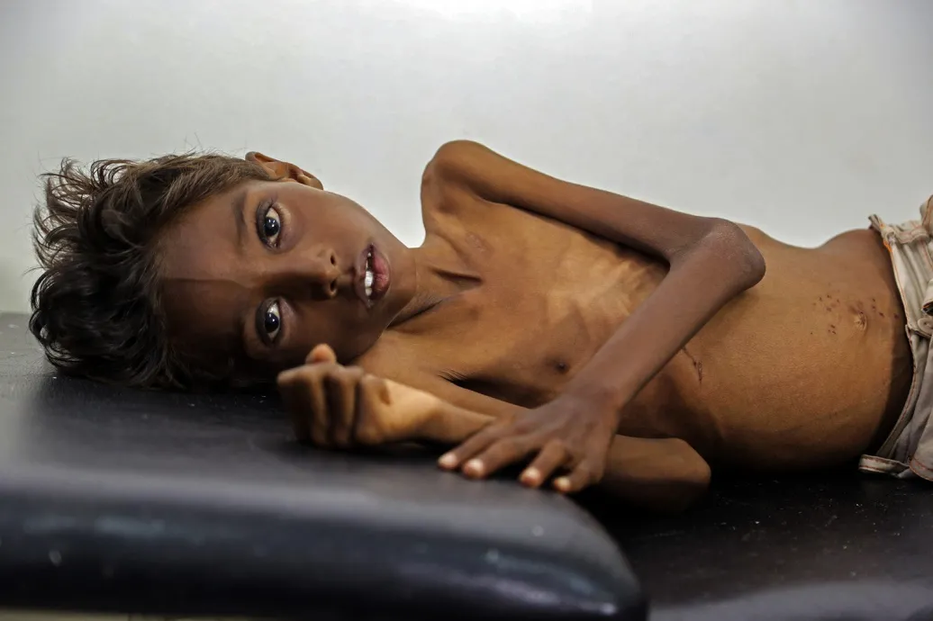 A five-year-old Yemeni boy suffers from severe acute malnutrition