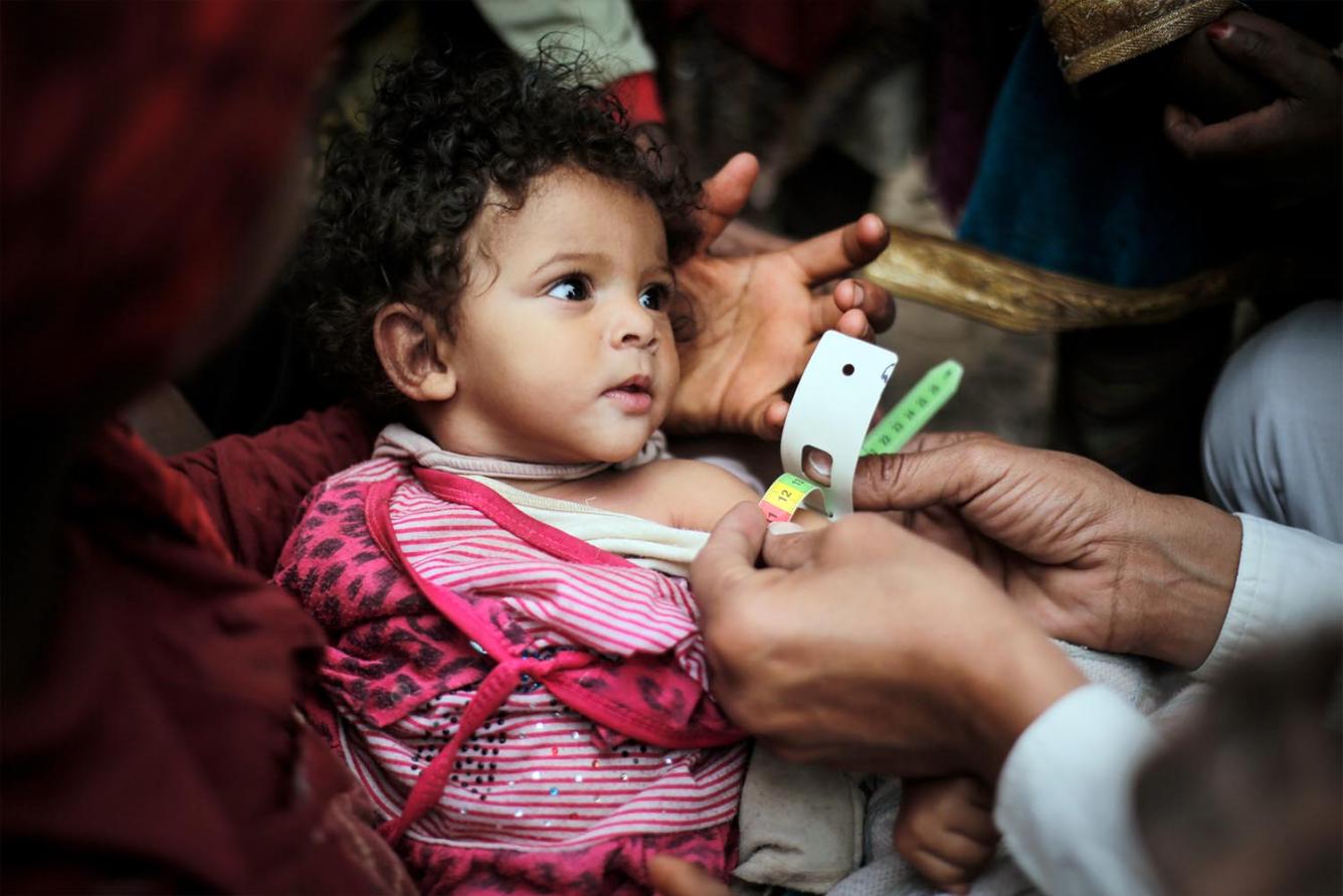 La petite Doa’a, âgée d’un an, souffrait de complications liées à la malnutrition sévère aiguë.
