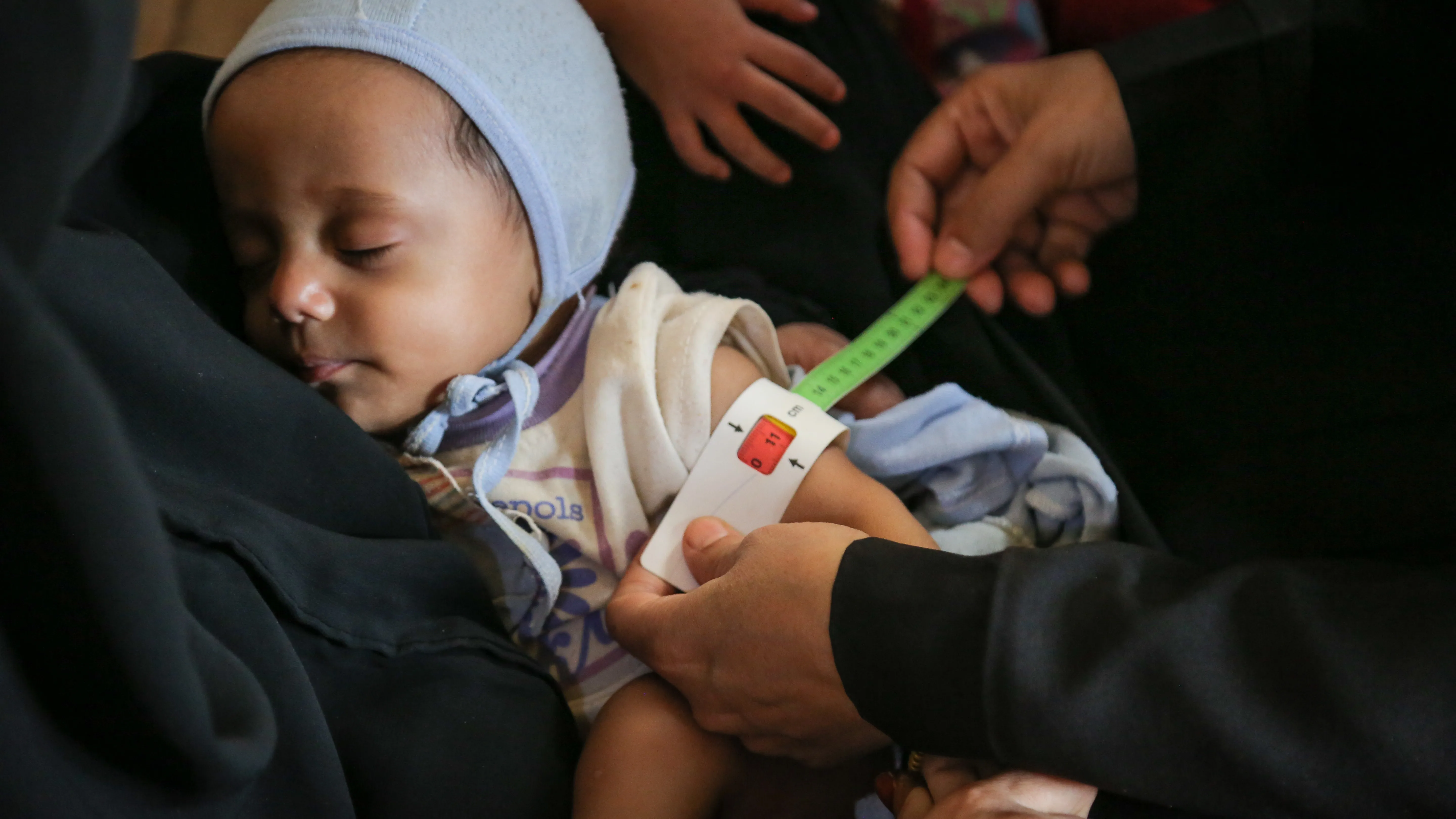 Salim is 7 months old, is screened by measure the upper arm circumference to check malnutrition.