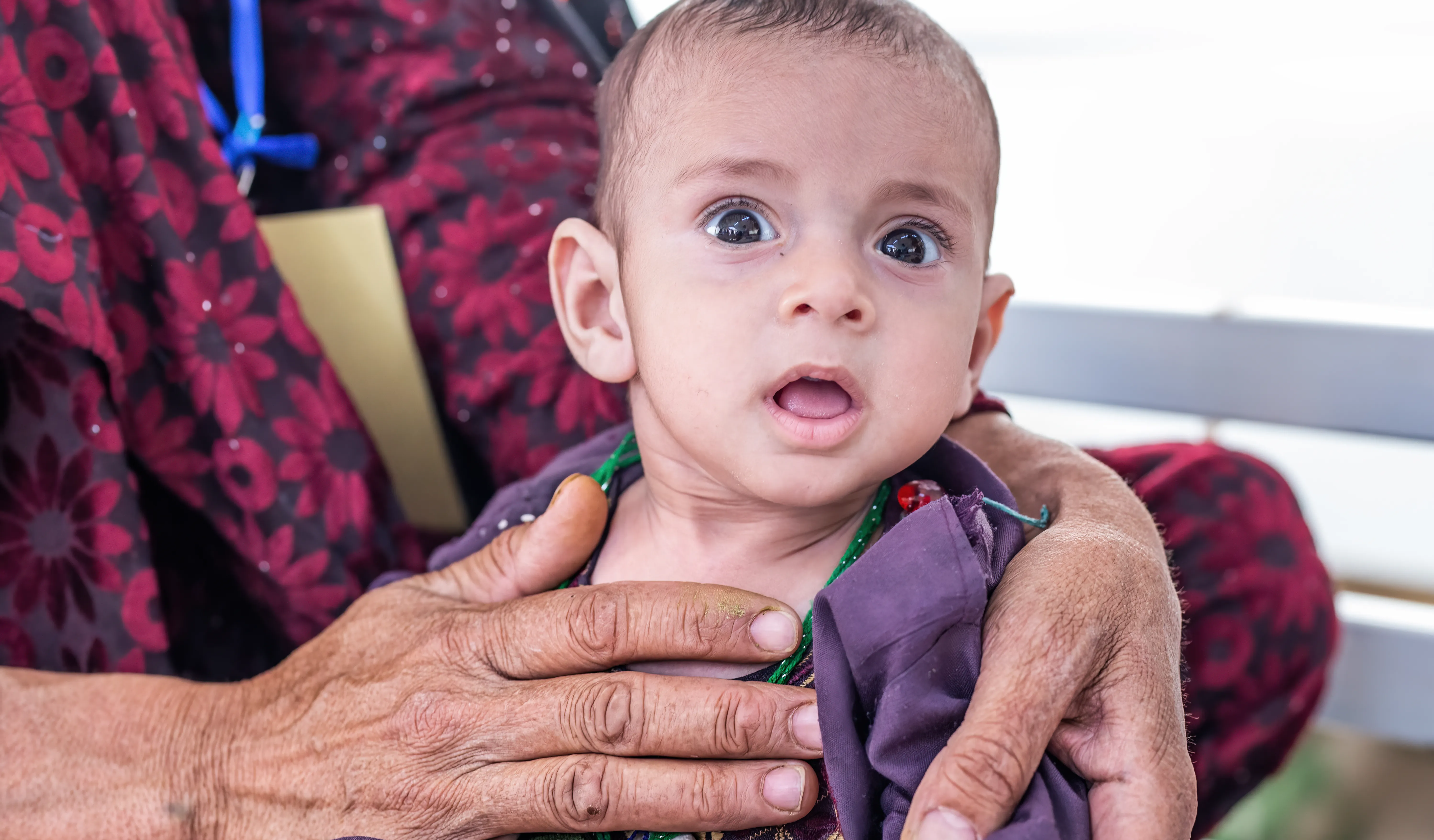 At the UNICEF-supported Inpatient Therapeutic Feeding Centre in Herat Regional Hospital, 15-month-old Javid who is suffering from severe acute malnutrition (SAM) with complication is provided with therapeutic food and medical care.