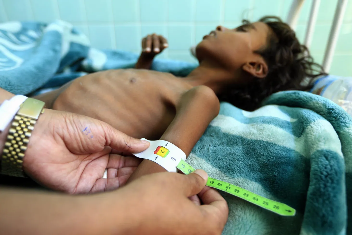 Un médecin mesure le bras d’Ali Mohammed Ahmed Jamal, un jeune yéménite de 12 ans, dans un hôpital de Sanaa.