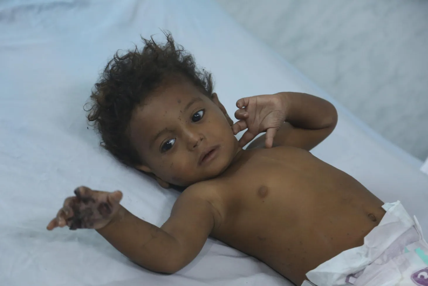 A baby lies in a hospital bed in Hodeidah, Yemen.
