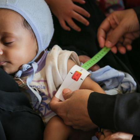 Salim is 7 months old, is screened by measure the upper arm circumference to check malnutrition.